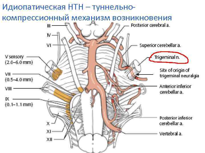Идиопатическая НТН – туннельнокомпрессионный механизм возникновения 