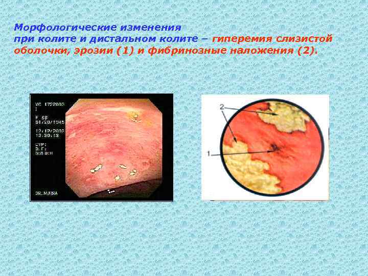 Морфологические изменения при колите и дистальном колите – гиперемия слизистой оболочки, эрозии (1) и