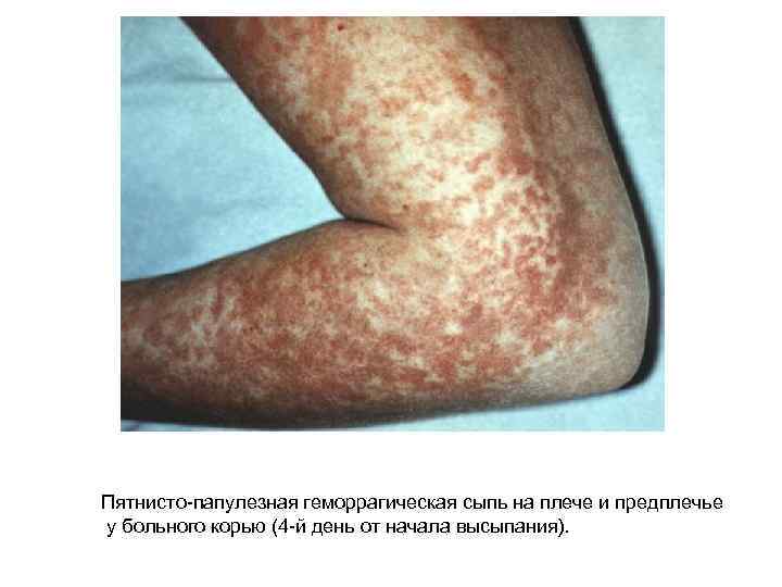 Пятнисто-папулезная геморрагическая сыпь на плече и предплечье у больного корью (4 -й день от