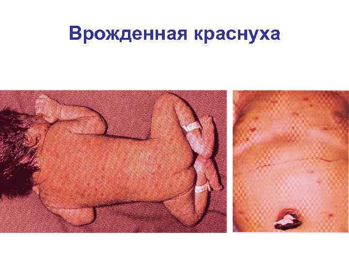 Врожденная краснуха Геморрагическая сыпь Гепатомегалия 
