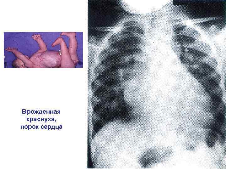 Врожденная краснуха, порок сердца 