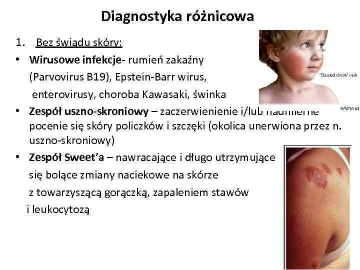Diagnostyka różnicowa 1. Bez świądu skóry: • Wirusowe infekcje- rumień zakaźny (Parvovirus B 19),