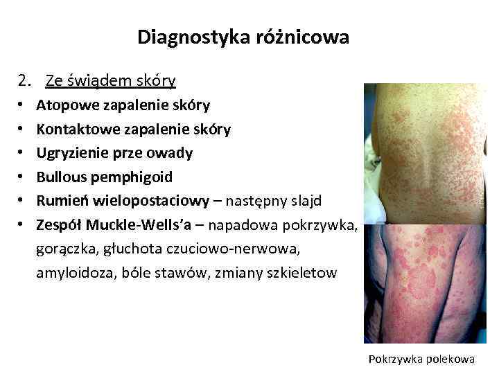 Diagnostyka różnicowa 2. Ze świądem skóry • Atopowe zapalenie skóry • Kontaktowe zapalenie skóry