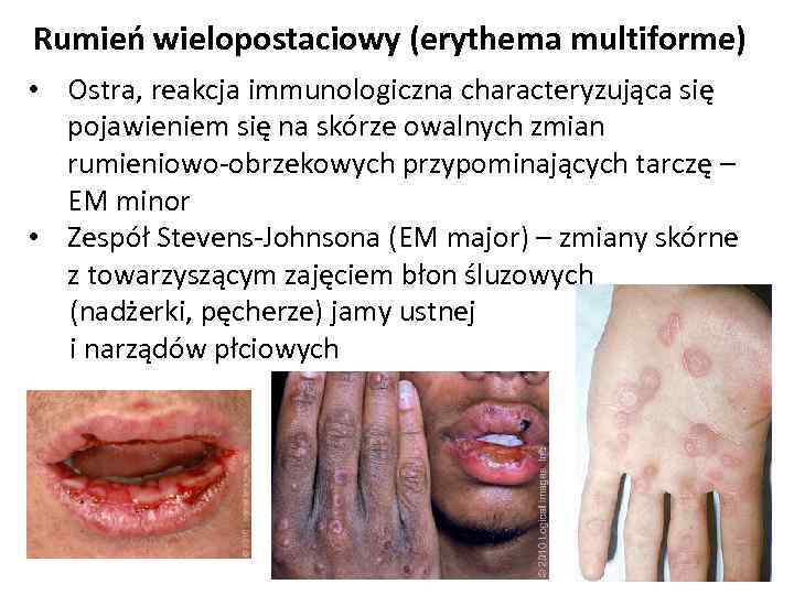 Rumień wielopostaciowy (erythema multiforme) • Ostra, reakcja immunologiczna characteryzująca się pojawieniem się na skórze