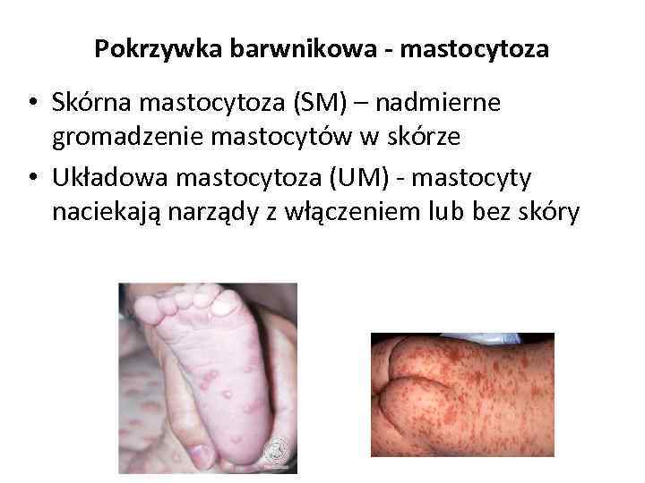 Pokrzywka barwnikowa - mastocytoza • Skórna mastocytoza (SM) – nadmierne gromadzenie mastocytów w skórze