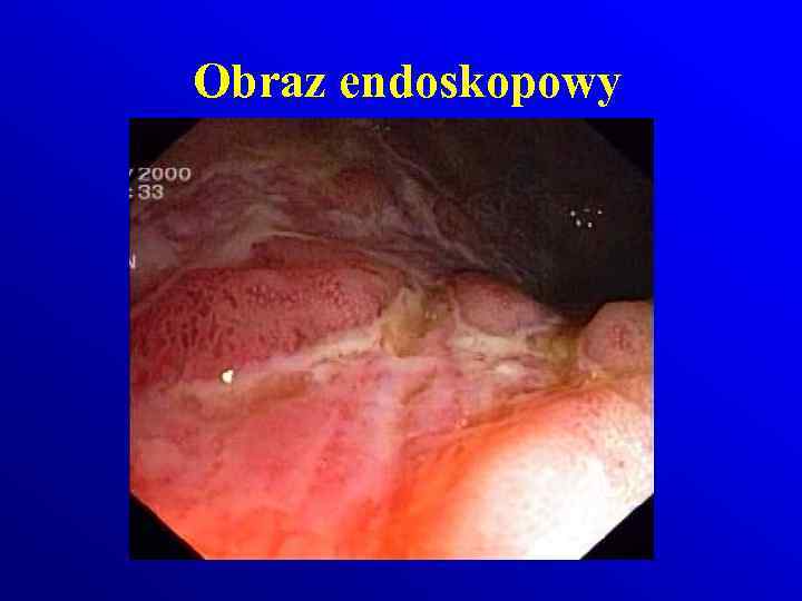 Obraz endoskopowy 