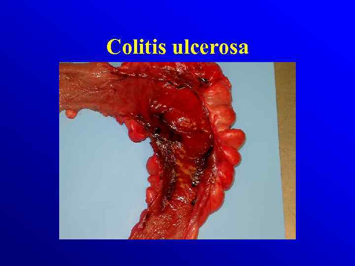Colitis ulcerosa 