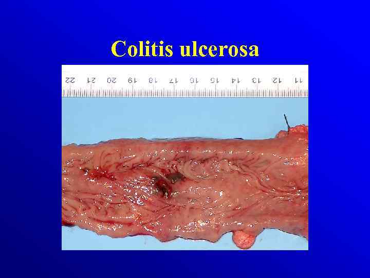 Colitis ulcerosa 