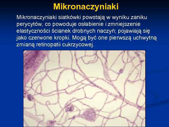 Mikronaczyniaki siatkówki powstają w wyniku zaniku perycytów, co powoduje osłabienie i zmniejszenie elastyczności ścianek