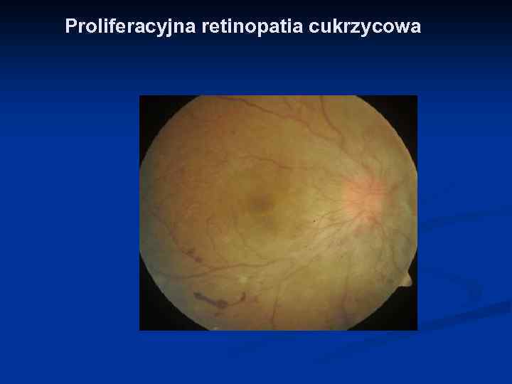 Proliferacyjna retinopatia cukrzycowa 
