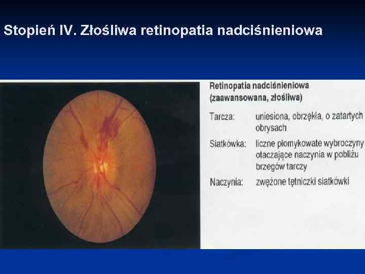 Stopień IV. Złośliwa retinopatia nadciśnieniowa 