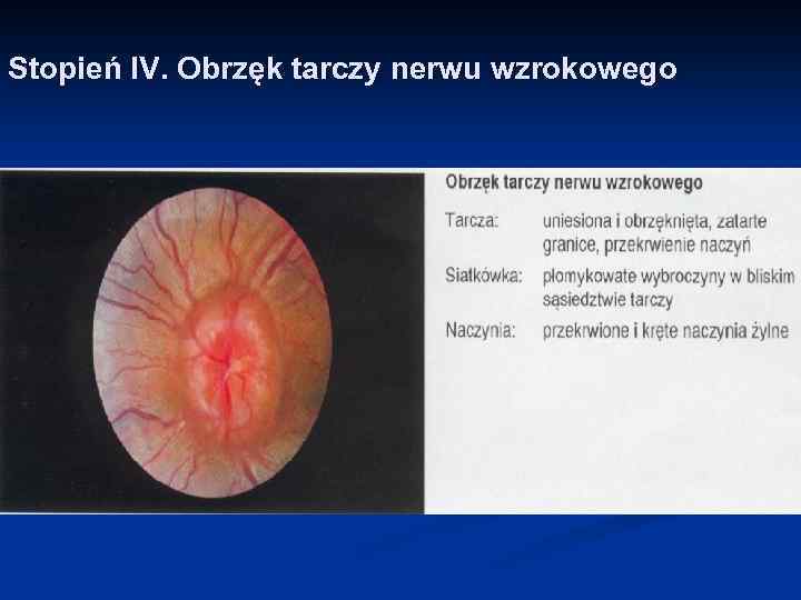 Stopień IV. Obrzęk tarczy nerwu wzrokowego 