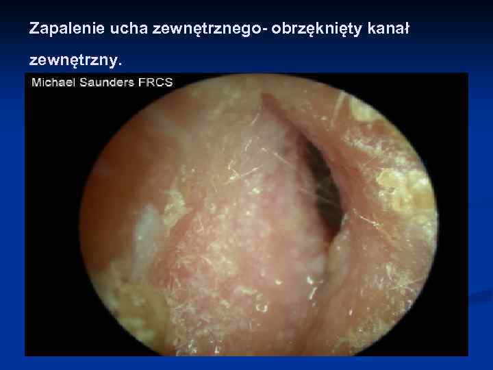 Zapalenie ucha zewnętrznego- obrzęknięty kanał zewnętrzny. 