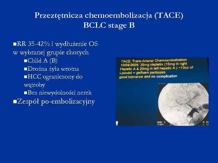 Przeztętnicza chemoembolizacja (TACE) BCLC stage B RR 35 -42% i wydłużenie OS w wybranej