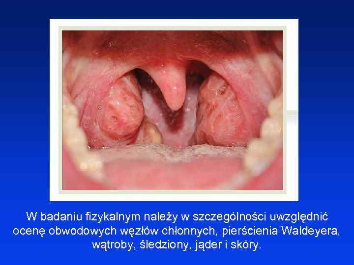 W badaniu fizykalnym należy w szczególności uwzględnić ocenę obwodowych węzłów chłonnych, pierścienia Waldeyera, wątroby,