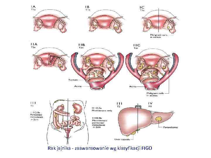 Rak jajnika - zaawansowanie wg klasyfikacji FIGO 