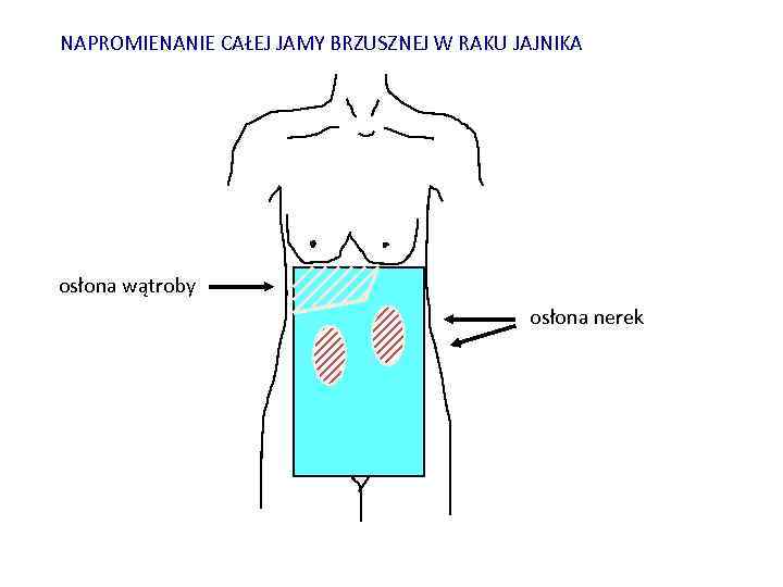 NAPROMIENANIE CAŁEJ JAMY BRZUSZNEJ W RAKU JAJNIKA osłona wątroby osłona nerek 