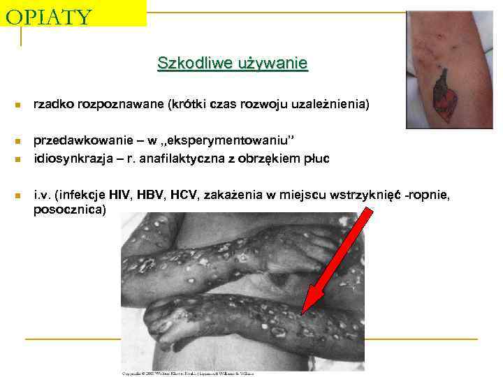 OPIATY Szkodliwe używanie n rzadko rozpoznawane (krótki czas rozwoju uzależnienia) n przedawkowanie – w