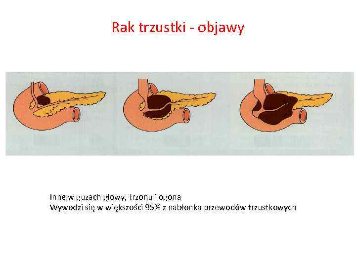 Rak trzustki - objawy Inne w guzach głowy, trzonu i ogona Wywodzi się w