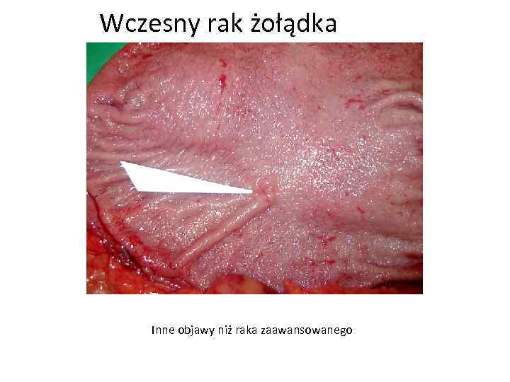 Wczesny rak żołądka Inne objawy niż raka zaawansowanego 