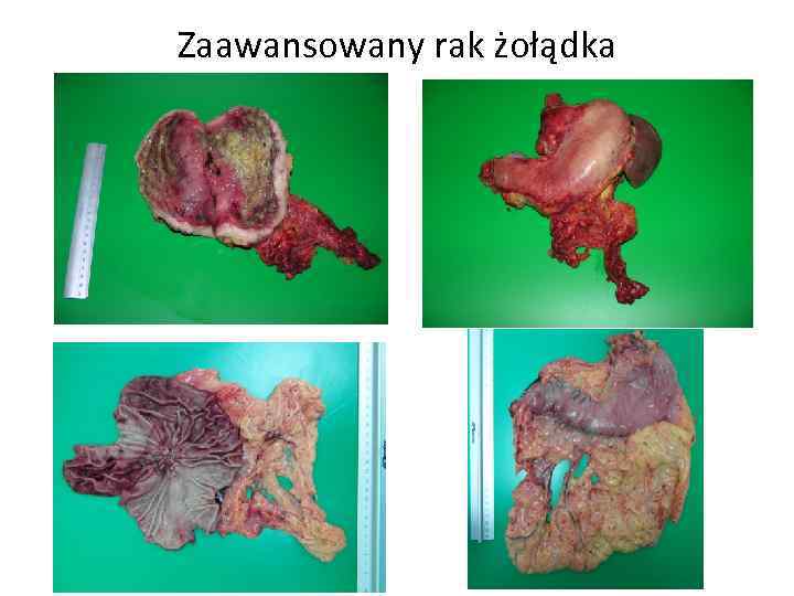 Zaawansowany rak żołądka 