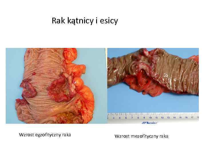 Rak kątnicy i esicy Wzrost egzofityczny raka Wzrost mezofityczny raka 