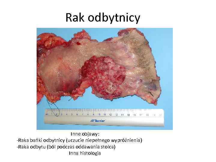 Rak odbytnicy Inne objawy: -Raka bańki odbytnicy (uczucie niepełnego wypróżnienia) -Raka odbytu (ból podczas