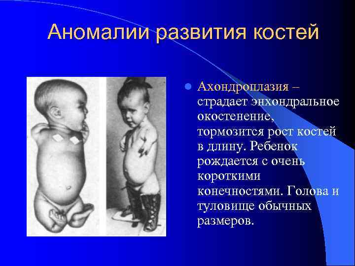 Аномалии развития костей l Ахондроплазия – страдает энхондральное окостенение, тормозится рост костей в длину.