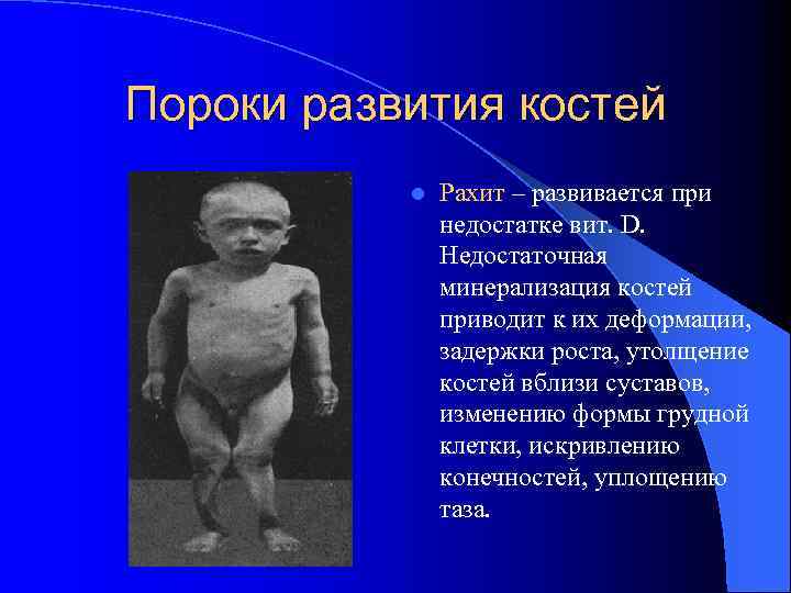Пороки развития костей l Рахит – развивается при недостатке вит. D. Недостаточная минерализация костей