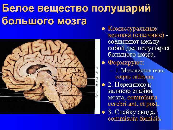 Белое вещество полушарий большого мозга l l Комиссуральные волокна (спаечные) соединяют между собой два
