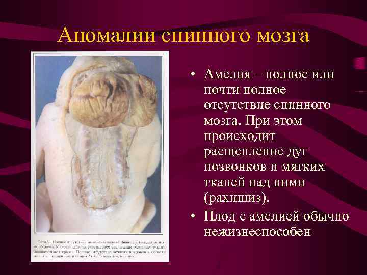 Аномалии спинного мозга • Амелия – полное или почти полное отсутствие спинного мозга. При