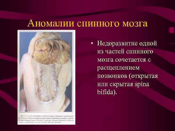 Аномалии спинного мозга • Недоразвитие одной из частей спинного мозга сочетается с расщеплением позвонков