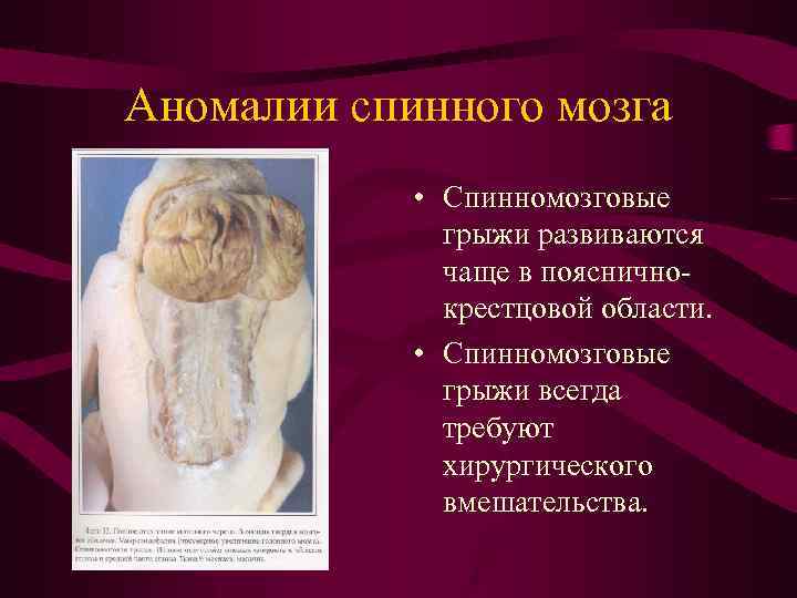 Аномалии спинного мозга • Спинномозговые грыжи развиваются чаще в поясничнокрестцовой области. • Спинномозговые грыжи