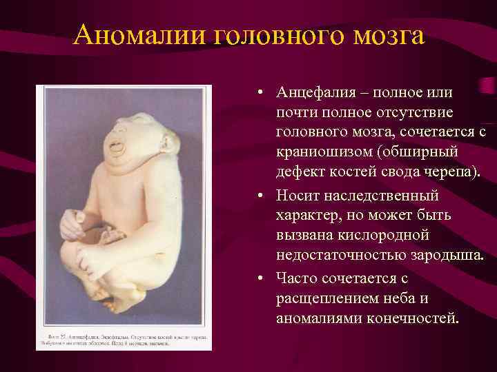 Аномалии головного мозга • Анцефалия – полное или почти полное отсутствие головного мозга, сочетается