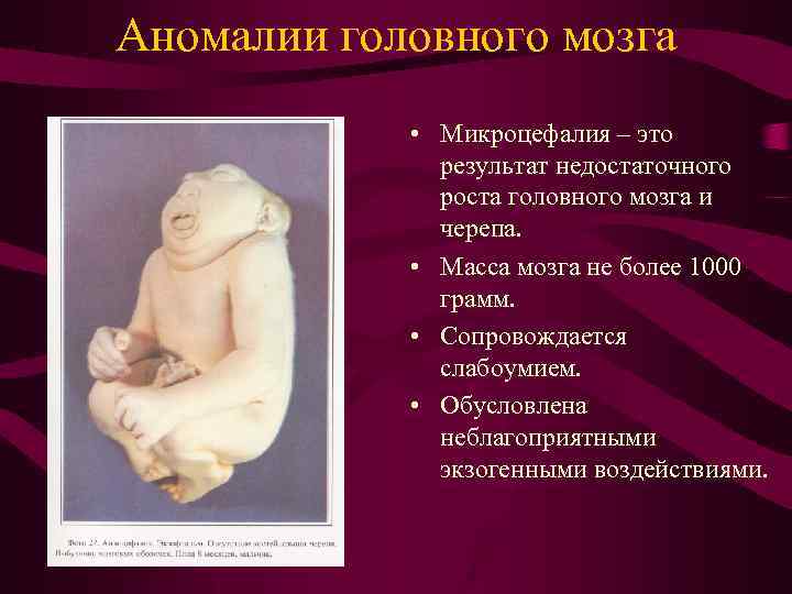 Аномалии головного мозга • Микроцефалия – это результат недостаточного роста головного мозга и черепа.