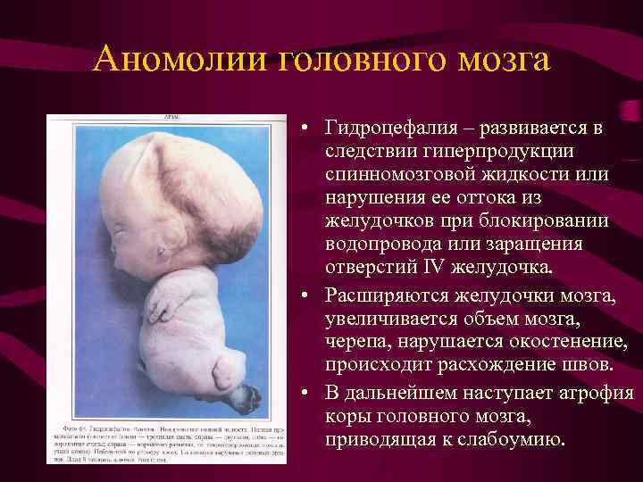 Аномолии головного мозга • Гидроцефалия – развивается в следствии гиперпродукции спинномозговой жидкости или нарушения