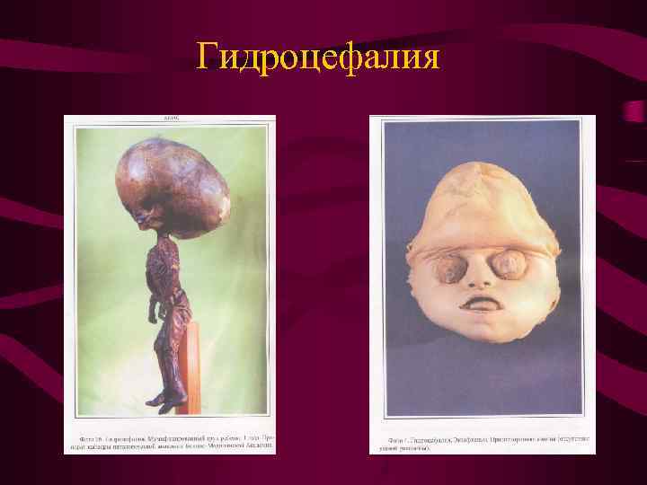 Гидроцефалия 