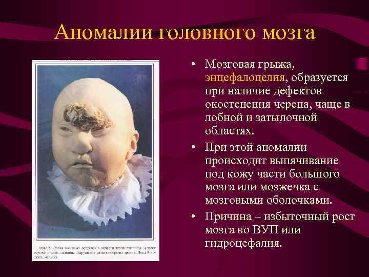 Аномалии головного мозга • Мозговая грыжа, энцефалоцелия, образуется при наличие дефектов окостенения черепа, чаще