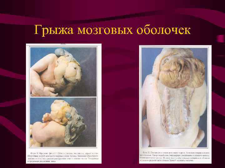 Грыжа мозговых оболочек 