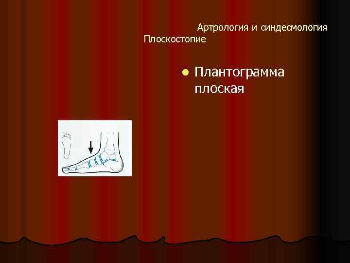 Артрология и синдесмология Плоскостопие l Плантограмма плоская 