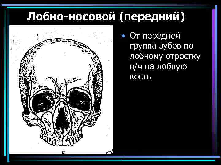 Лобно-носовой (передний) • От передней группа зубов по лобному отростку в/ч на лобную кость