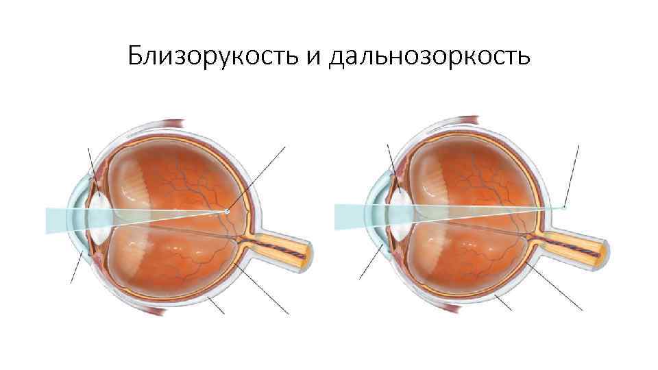 Глаз и зрение близорукость и дальнозоркость очки 8 класс презентация