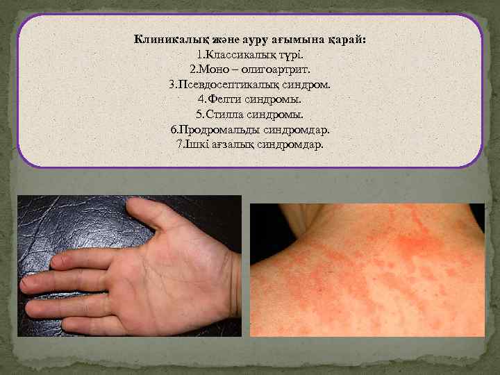 Клиникалық және ауру ағымына қарай: 1. Классикалық түрі. 2. Моно – олигоартрит. 3. Псевдосептикалық