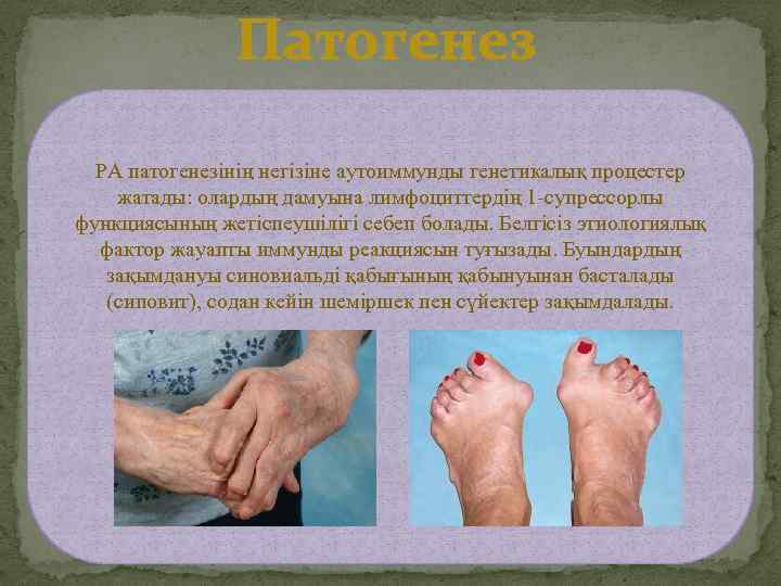 Патогенез РА патогенезінің негізіне аутоиммунды генетикалық процестер жатады: олардың дамуына лимфоциттердің 1 -супрессорлы функциясының