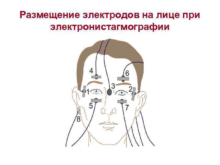 Размещение электродов на лице при электронистагмографии 