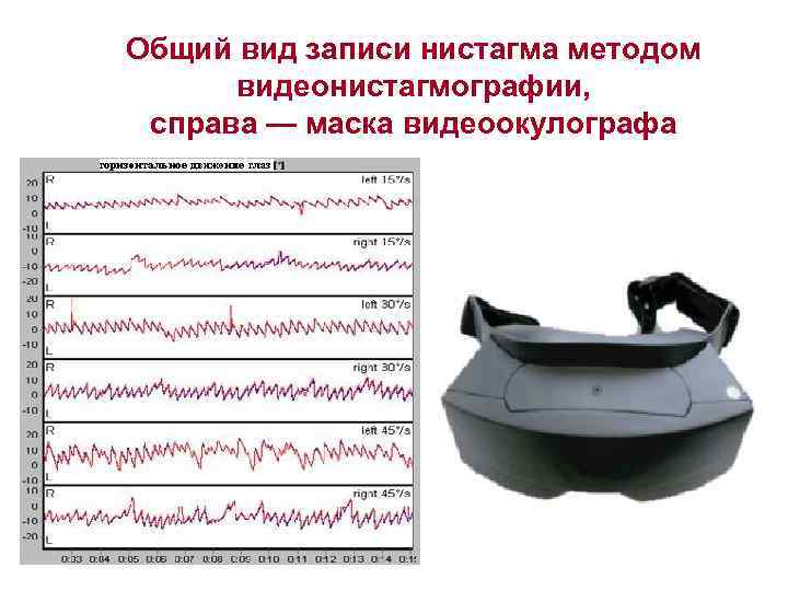 Общий вид записи нистагма методом видеонистагмографии, справа — маска видеоокулографа 