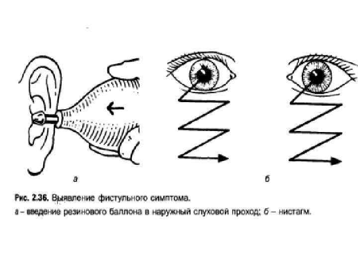 Вращательная проба. Термальное исследование вестибулярного аппарата. Методы исследования вестибулярного аппарата. Пробы для оценки вестибулярного аппарата. Исследование вестибулярного анализатора.