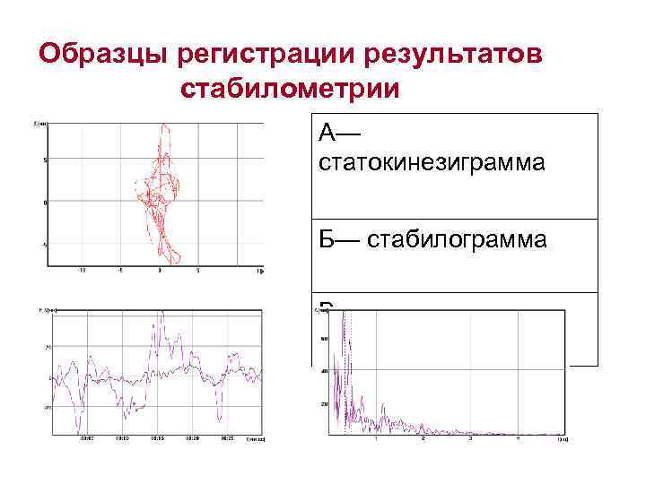 Образцы регистрации результатов стабилометрии А— статокинезиграмма Б— стабилограмма В - спектрограмма 