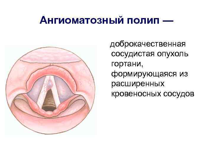 Ангиоматозный полип — доброкачественная сосудистая опухоль гортани, формирующаяся из расширенных кровеносных сосудов 