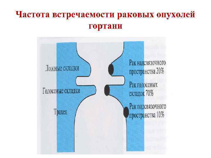 Частота встречаемости раковых опухолей гортани 
